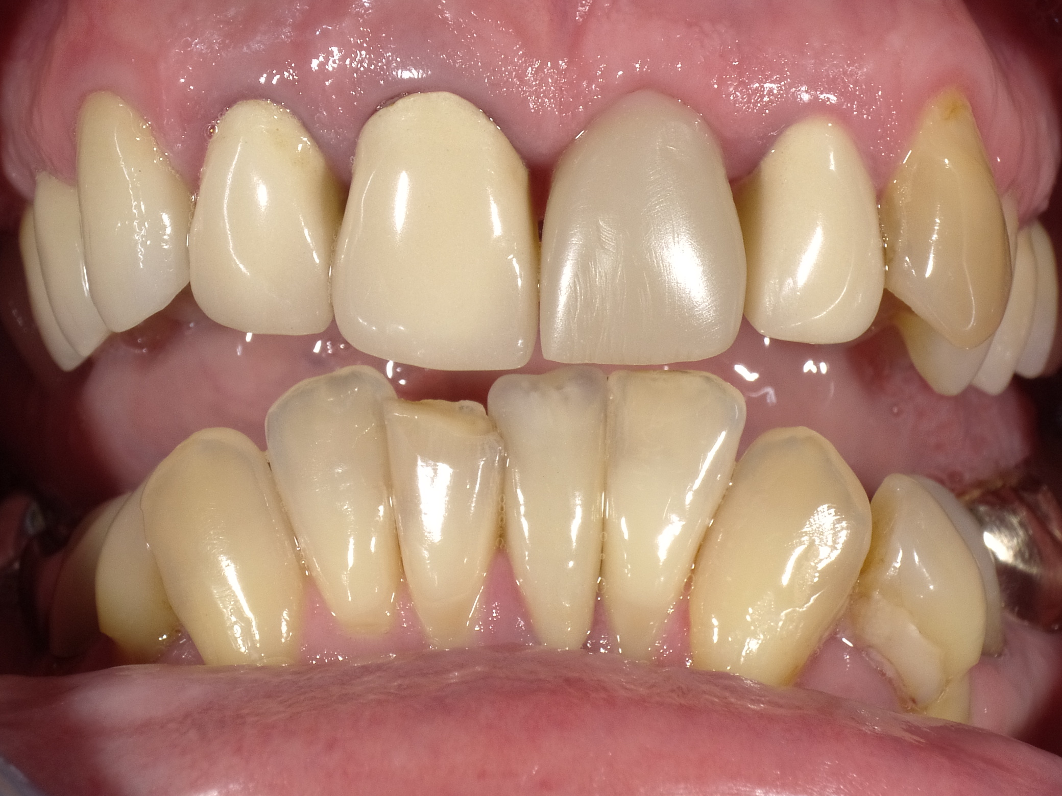 Gelbliche, camembertfarbige Kronen und dunkler Frontzahn nach Wurzelbehandlung